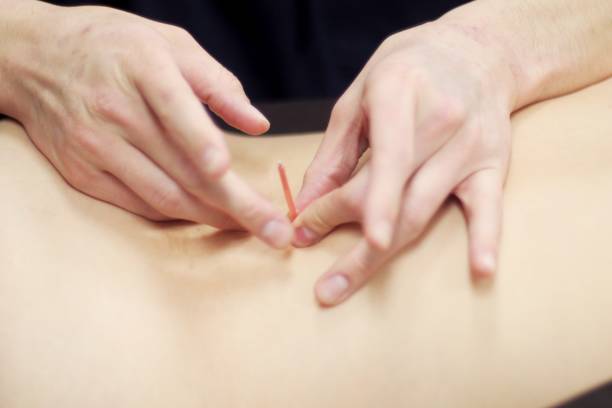 istock Woman receiving acupuncture 670792818