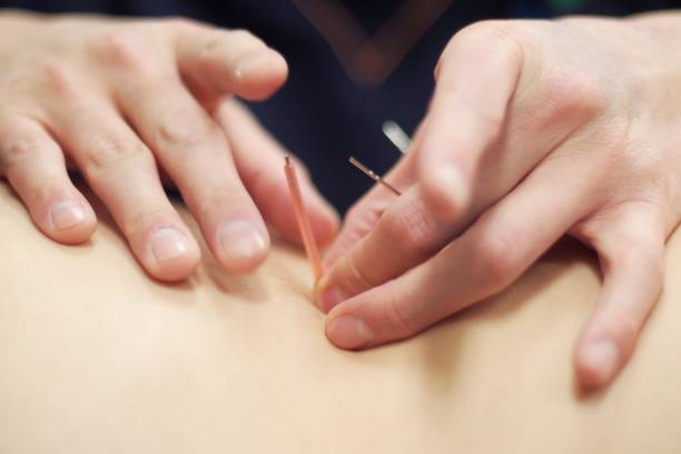 istock Woman receiving acupuncture 670803654