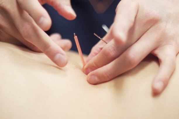 istock Woman receiving acupuncture 670803660