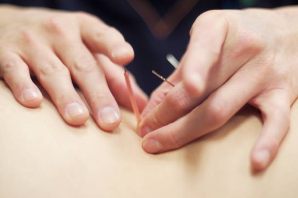 istock Woman receiving acupuncture 670803696