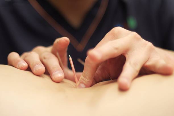 istock Woman receiving acupuncture 670803734