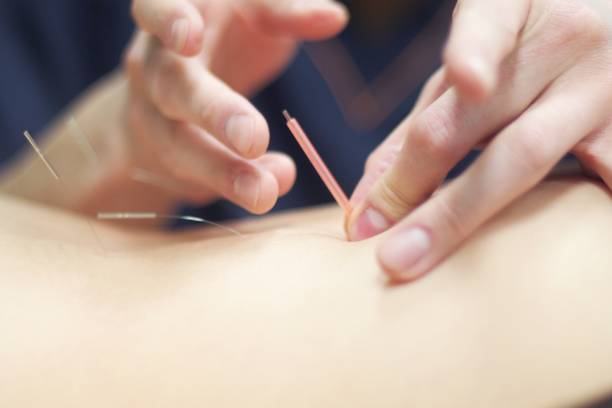istock Woman receiving acupuncture 670803814