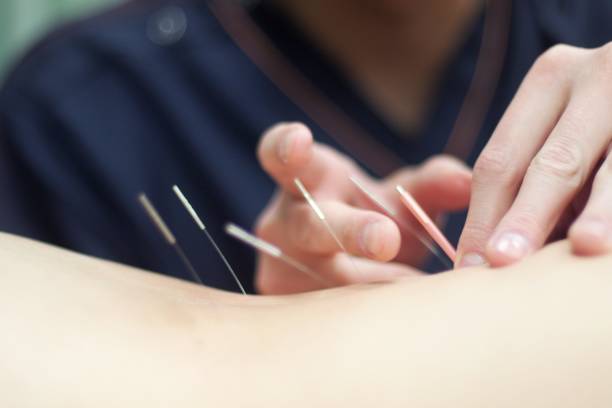 istock Woman receiving acupuncture 670803878