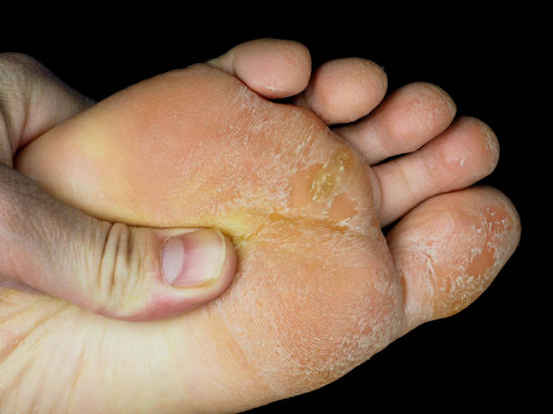 Skin peeling off from under foot, at closeup towards black stock photo