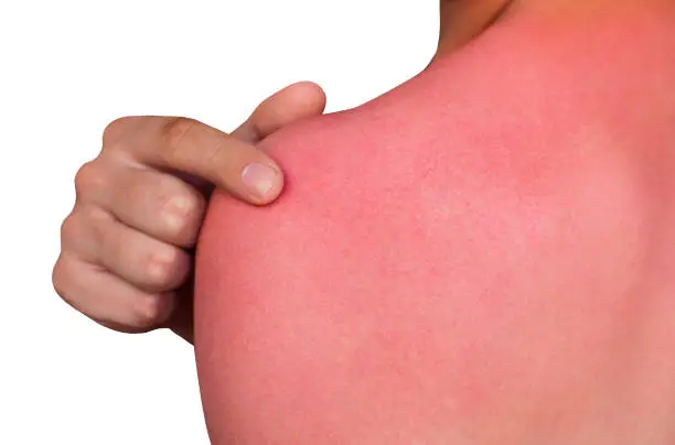 A man with reddened, itchy skin after sunburn. Skin care and protection from the sun's ultraviolet rays.