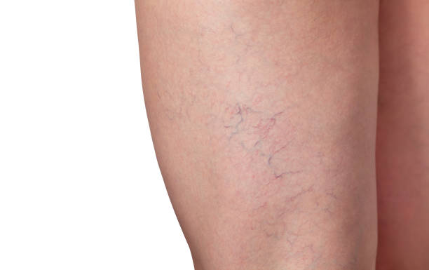 vene varicose e vene capillari nelle gambe - laser therapy medical laser light therapy foto e immagini stock