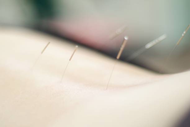 istock Woman receiving acupuncture 671111512