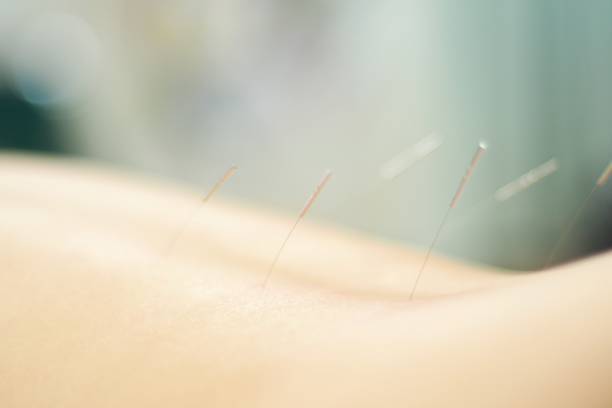 istock Woman receiving acupuncture 671111514