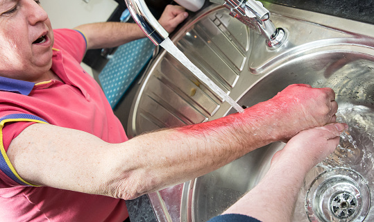 A man suffering  a serious scold in a home setting being assisted by first aider / friend or paramedic - arm very red from injury being doused in cold water to relieve the symptoms