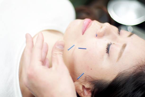istock Woman receiving acupuncture on face 671207682