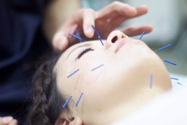 istock Woman receiving acupuncture on face 671207684