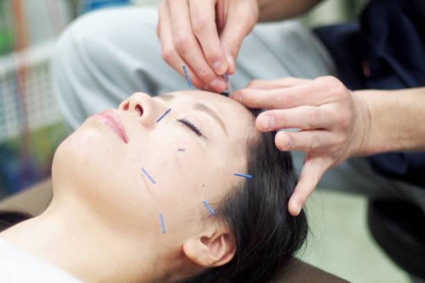 istock Woman receiving acupuncture on face 671207710