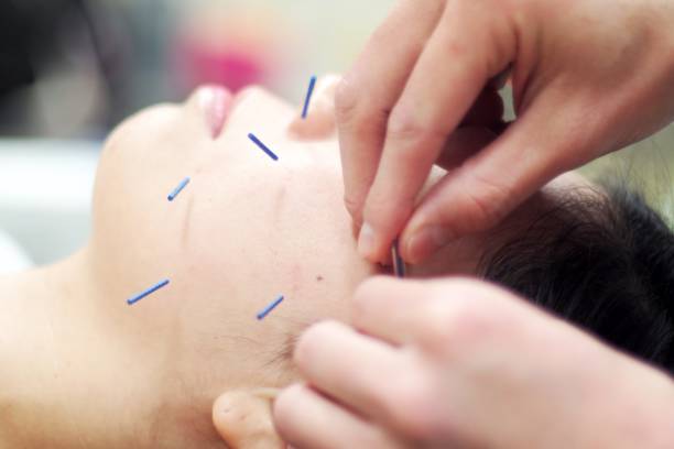 istock Woman receiving acupuncture on face 671207712