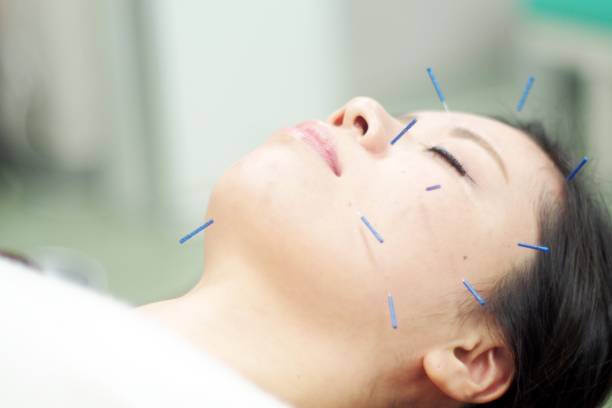 istock Woman receiving acupuncture on face 671211072