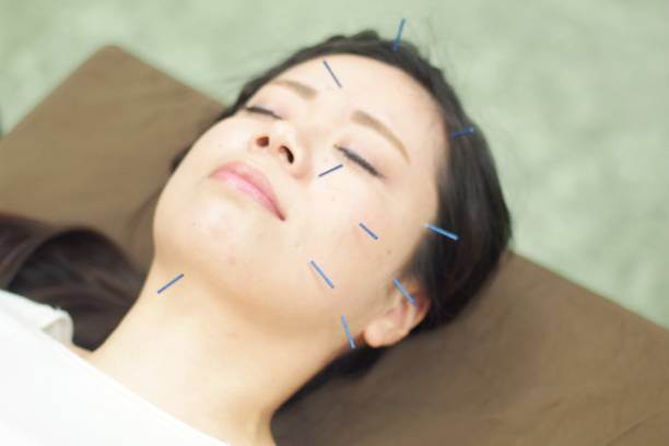 istock Woman receiving acupuncture on face 671211080