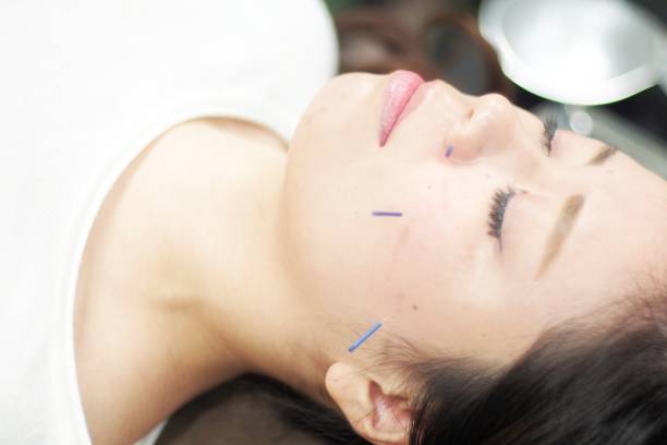 istock Woman receiving acupuncture on face 671211084