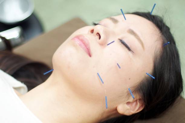istock Woman receiving acupuncture on face 671211086
