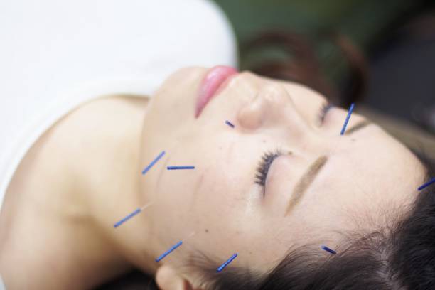 istock Woman receiving acupuncture on face 671211140