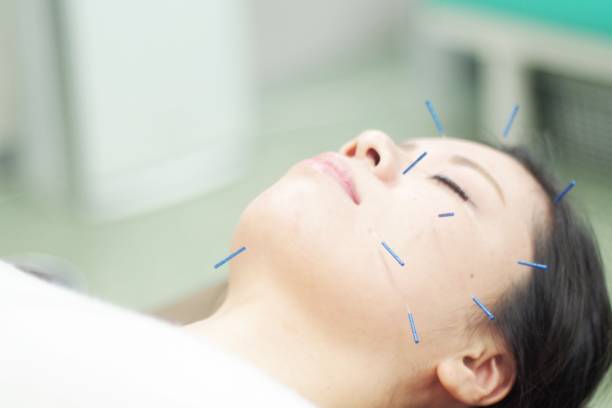 istock Woman receiving acupuncture on face 671211144
