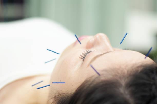 istock Woman receiving acupuncture on face 671211150