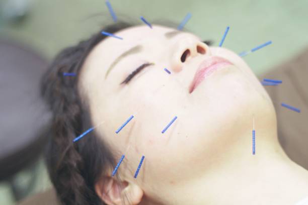 istock Woman receiving acupuncture on face 671211880