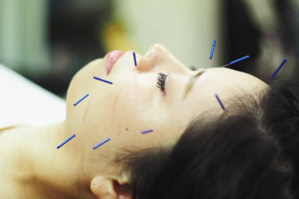 istock Woman receiving acupuncture on face 671216526