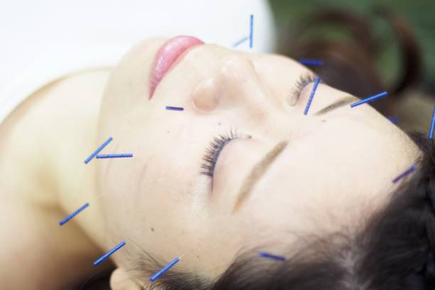 istock Woman receiving acupuncture on face 671218234