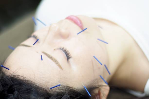 istock Woman receiving acupuncture on face 671218264