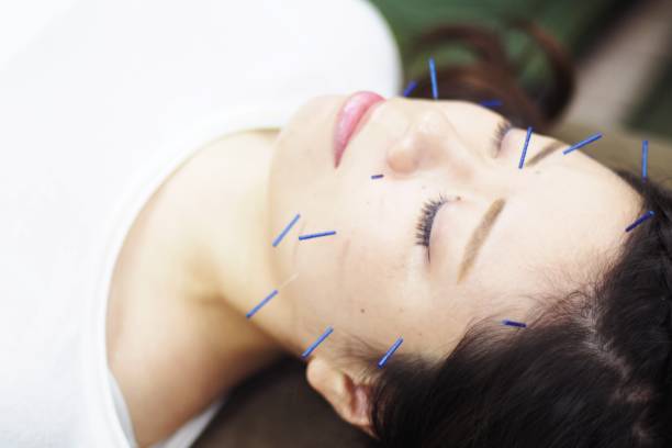 istock Woman receiving acupuncture on face 671218266