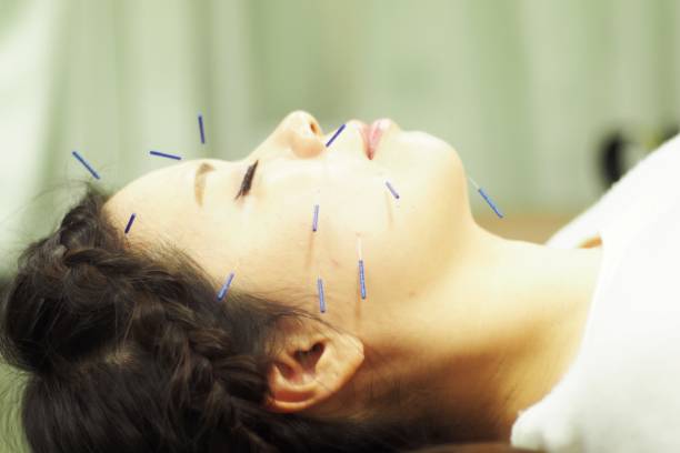 istock Woman receiving acupuncture on face 671218314