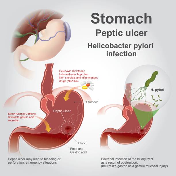 wrzód trawienny żołądka. - peptic ulcer stock illustrations