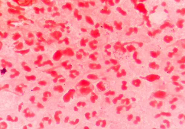 Moderate red white blood cells with gram negative diplococci intracellular.Neisseria gonorrhoeae also known as gonococci , is a species of Gram-negative coffee bean-shaped diplococci bacteria responsible for the sexually transmitted infection gonorrhea
