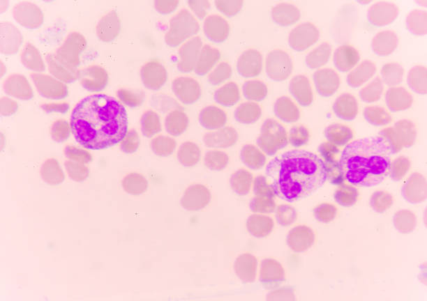 istock Abnormal neutrophil in blood smear 671511956