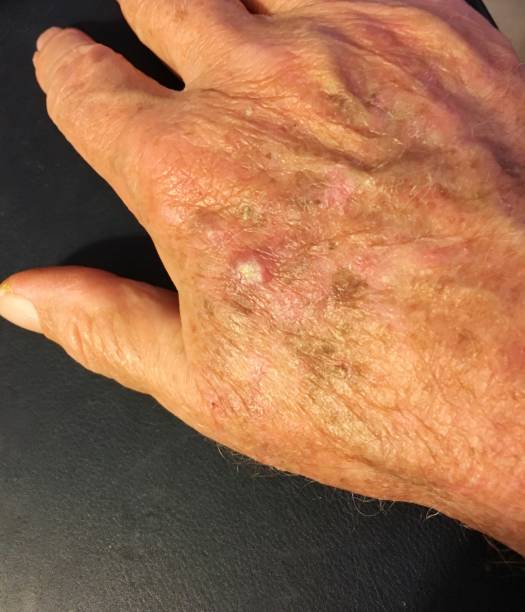 Actinic keratosis-편평 세포 피부 암 전조 스톡 사진