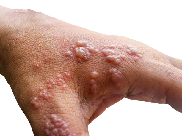haut infizierte herpes-zoster-virus auf den armen - zoster stock-fotos und bilder