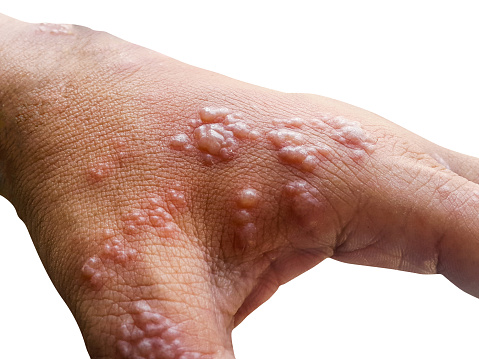 Piel infectada Herpes zóster en los brazos photo