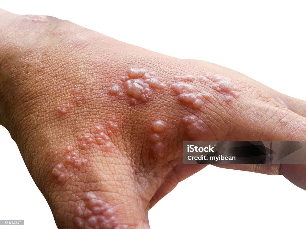 La peau infectée herpès zoster virus sur les bras - Photo de Zona libre de droits