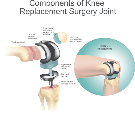 Components Of Knee Replacement Surgery Joint Stock Illustration - Download  Image Now - Artificial Knee, Knee, Knee Length - iStock