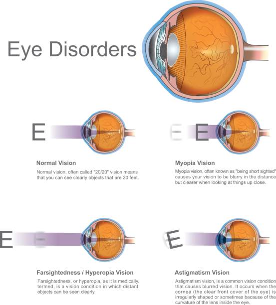 Eye disorders. They may not be painful and you may not see changes in your vision until the disease has become very advanced. Vector graphic. concave illustrations stock illustrations