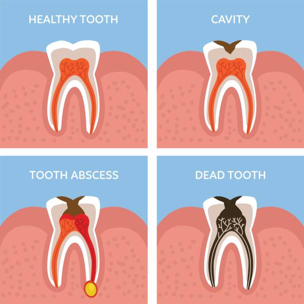 Teeth Stages of tooth decay. Dental anatomy concept. Vector illustration. abscess stock illustrations