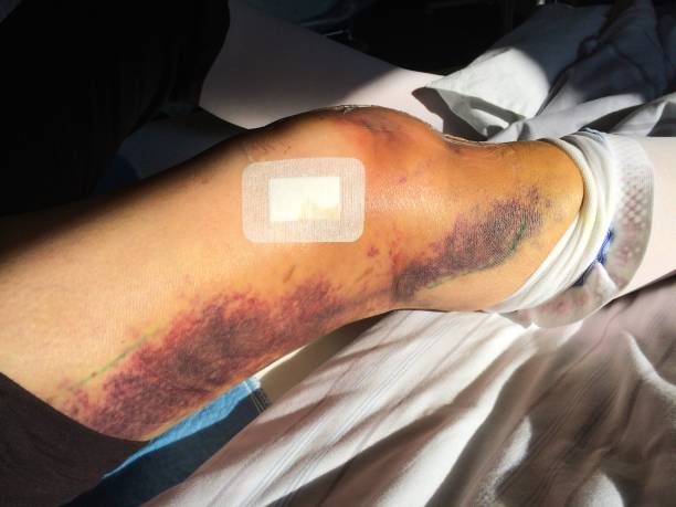 Knee replacement incision Knee replacement incision by a eldery woman knee contusion bruised knee stock pictures, royalty-free photos & images