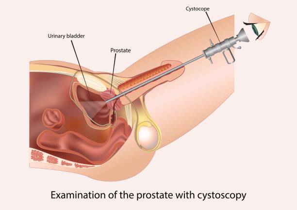 Examination of the prostate with cystoscopy Examination of urethra tracts by cystoscopy genital herpes stock illustrations