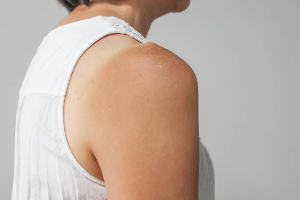 Sunburn shoulder stock photo