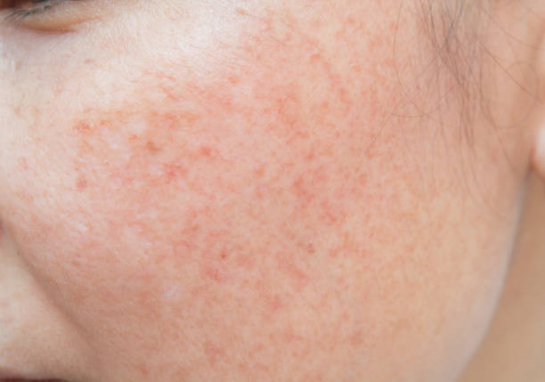 istock The freckles and freckles 673925708