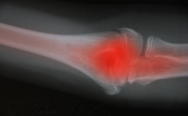istock Close up Thigh bone  x-ray medical science background 673940778