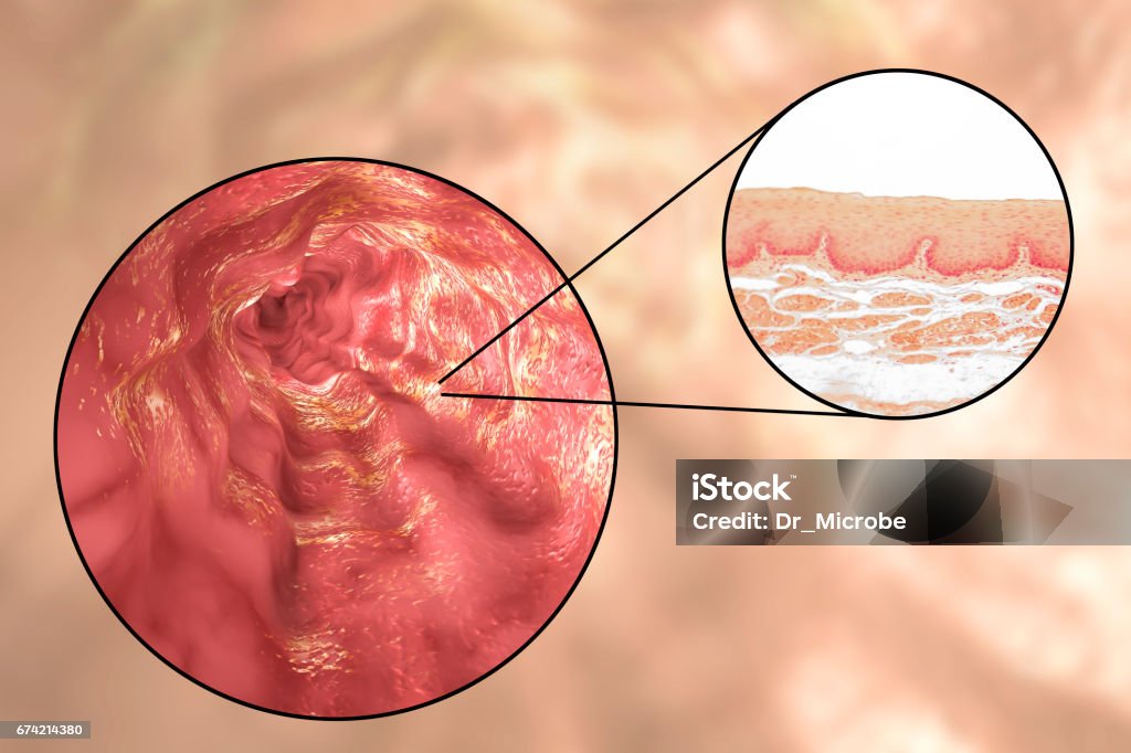 Humano esophagous, Ilustración y micrográfo ligero - Ilustración de stock de Afección médica libre de derechos