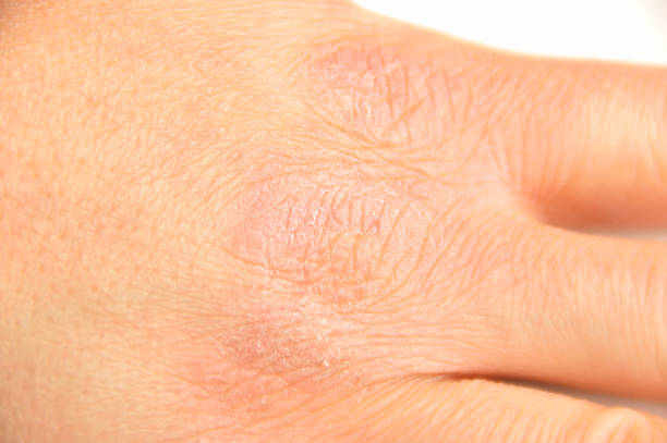 istock hand with very dry skin 674265296