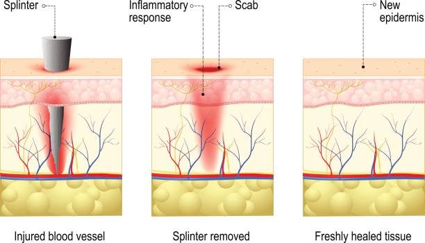 skin with splinter and wound healing skin with splinter and wound healing. process in body tissue repairs after trauma. cross section of the human skin sliver stock illustrations