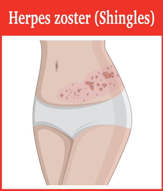 Illustration of Herpes zoster Symptoms of shingles on the abdomen of a girl tinea stock illustrations