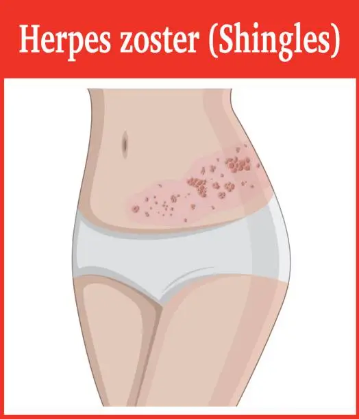Vector illustration of Illustration of Herpes zoster